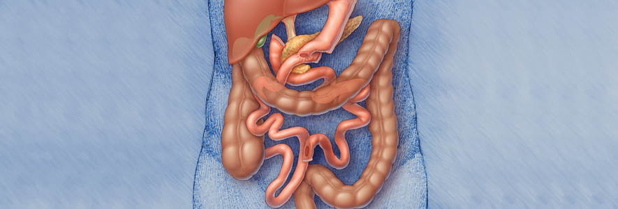 duodenal-switch