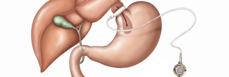 gastric-banding