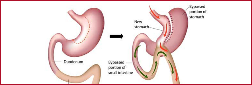 gastric-bypass