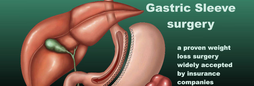 gastric-sleeve
