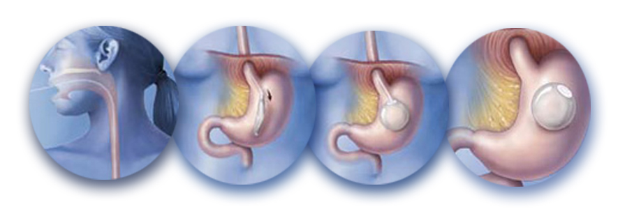 intragastric-balloon