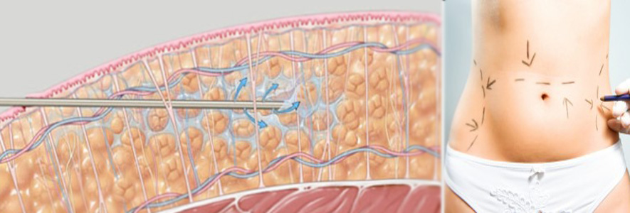 liposuction